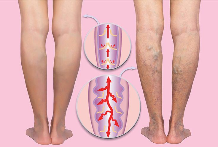 Varicose Veins